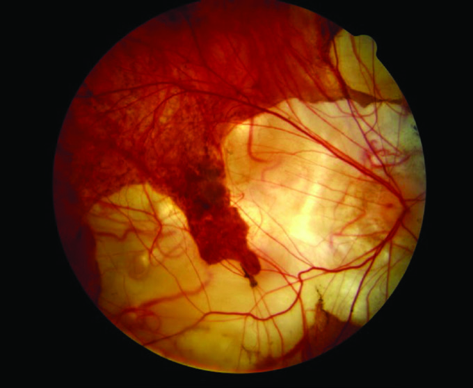 Clinical photography: Myopic degeneration | Specsavers ProFile